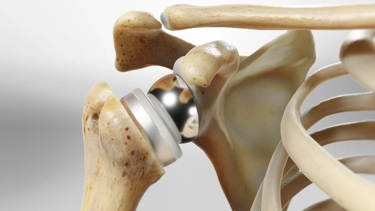 Shoulder Replacement: Expert Care | Aptiva Health